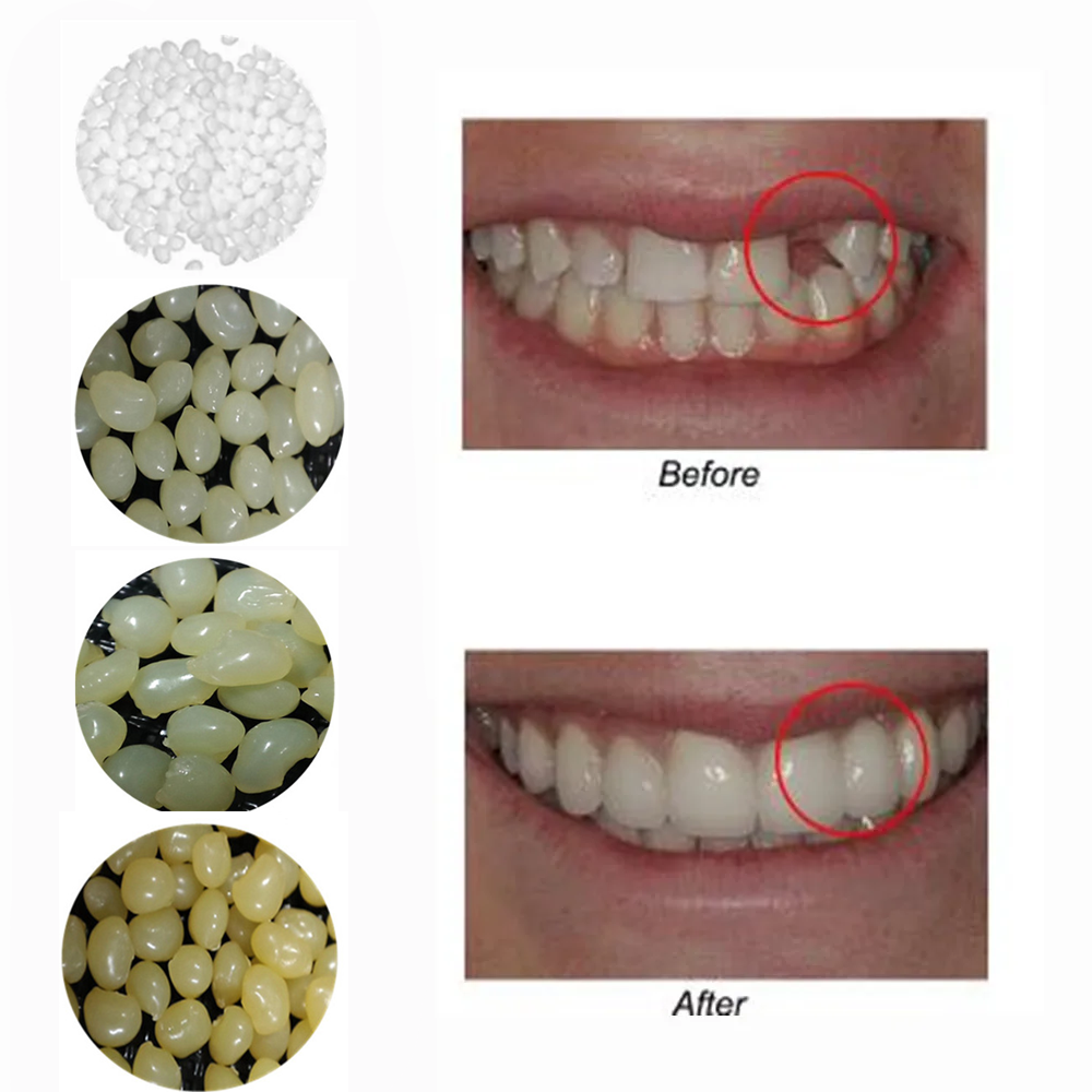 Teeth Whitening Uv Kit - 4 Colors Dental Oral False Fake