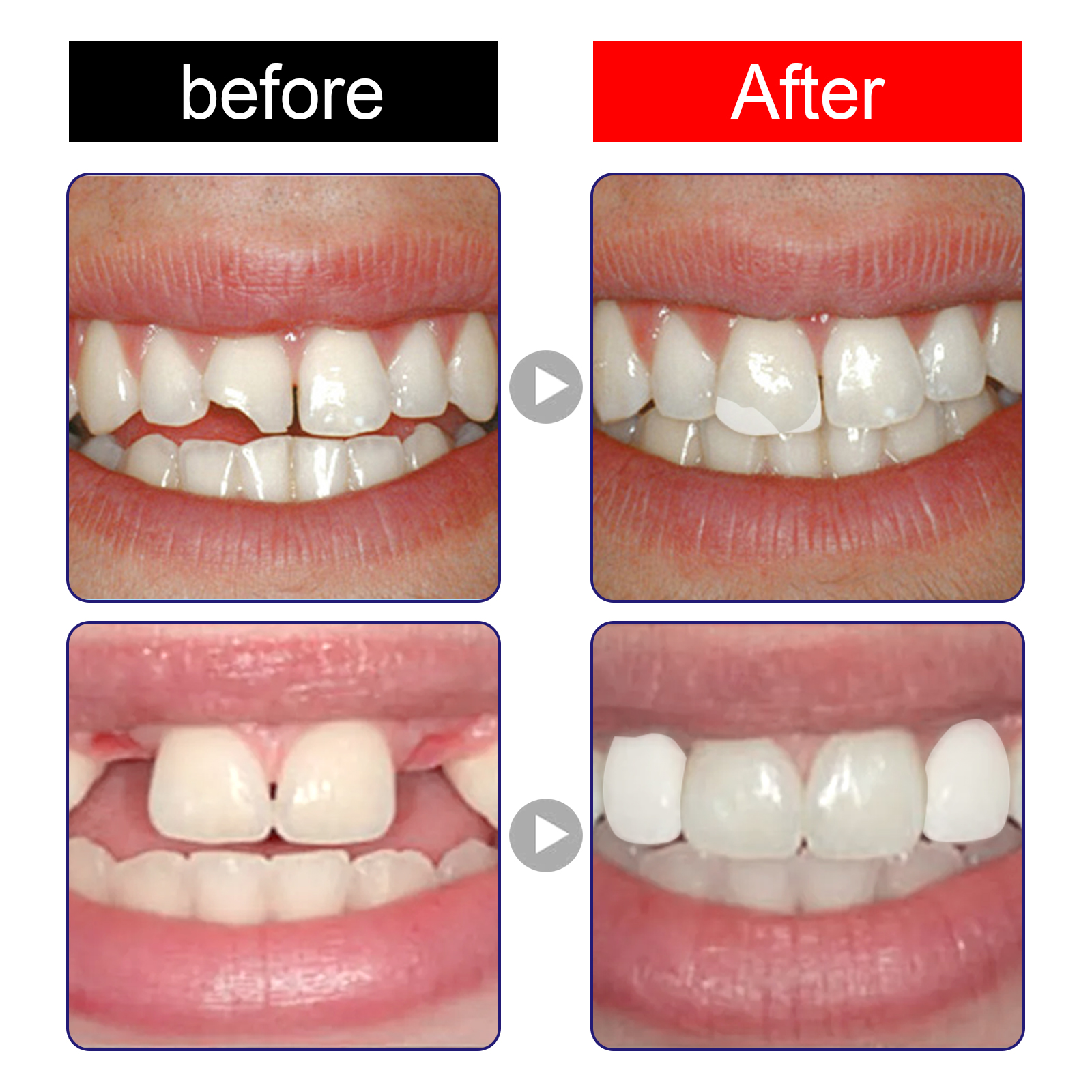 Moldable Dental Filling Materi - огляд і ціна Teeth Whitening Uv Kit