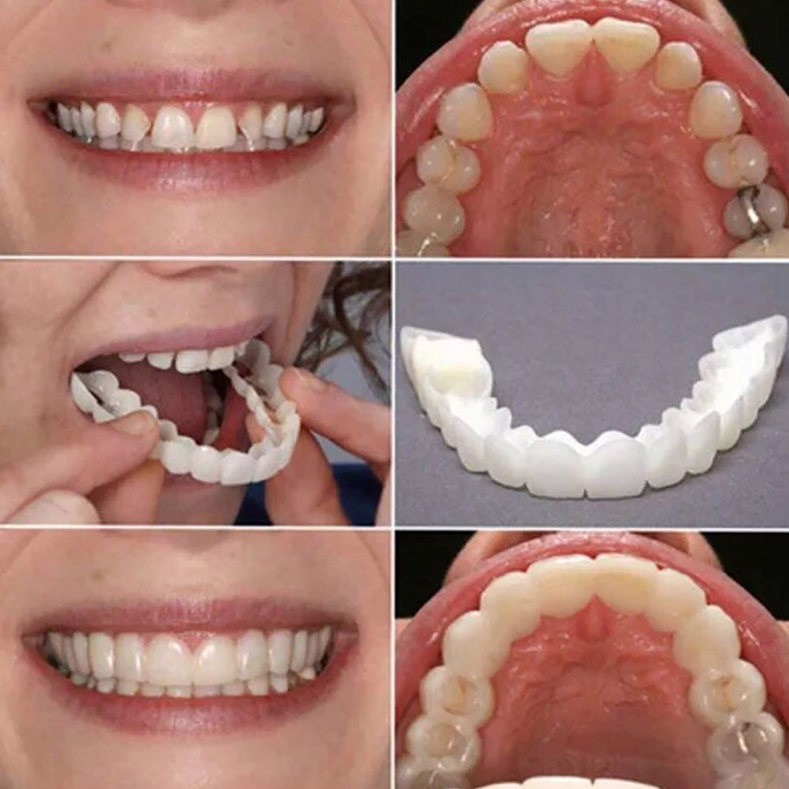 Hot Teeth Veneers Whitening De - огляд і ціна Teeth Whitening With Braces