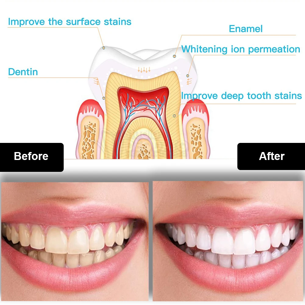 Dental Teeth Whitening Kit Min - огляд і ціна Teeth Whitening Gel Pen