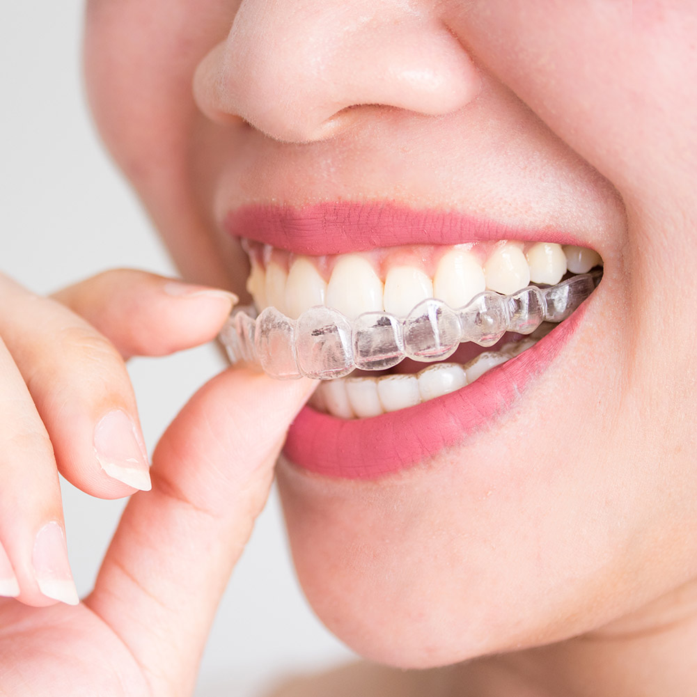 2/4pcs Mouth Guard Teeth Prote - огляд і ціна Teeth Whitening With Braces