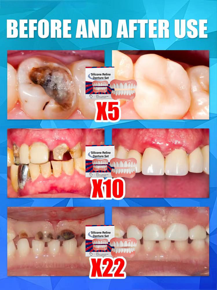 False Teeth Silicone Upper Low - огляд і ціна Teeth Whitening With Braces